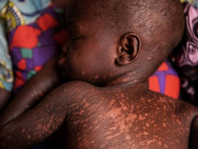 Measles Outbreak in Nigeria