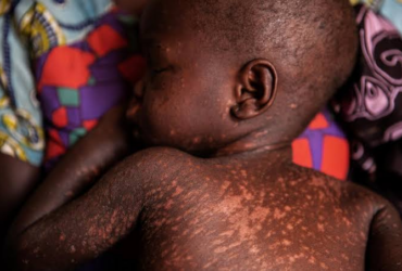 Measles Outbreak in Nigeria